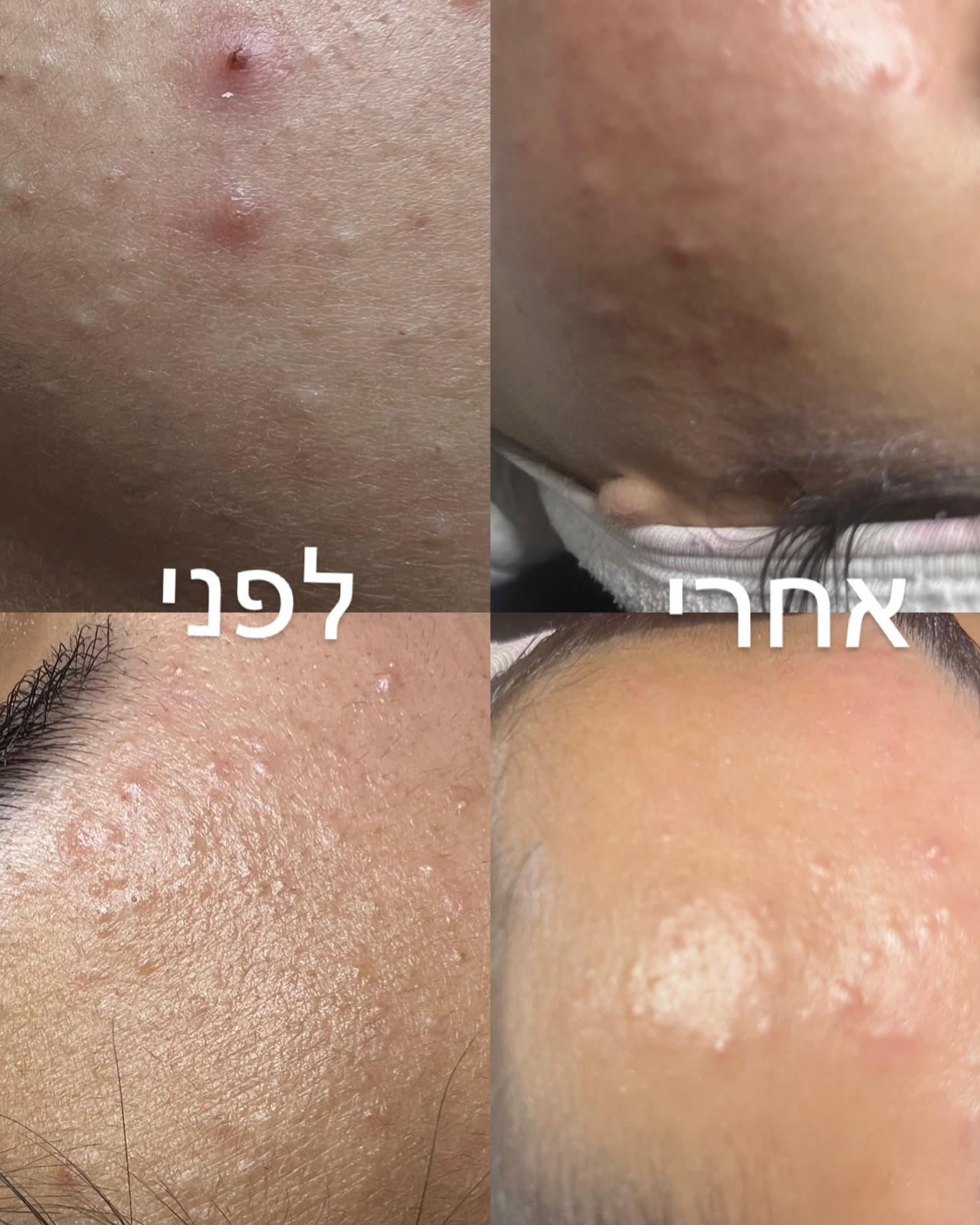 טיפול באקנה ברותם פלייס — לפני ואחרי